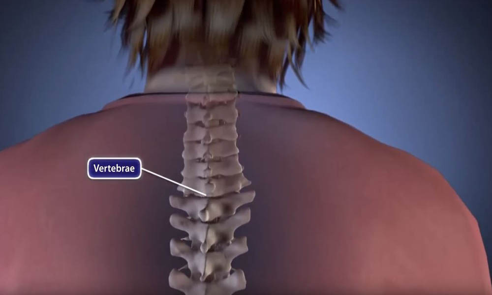 Neck Pain After Spinal