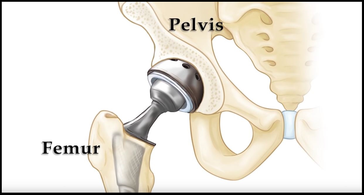 Revision Total Hip Replacement Orthoinfo Aaos 4108