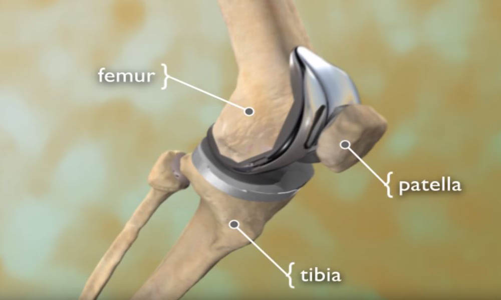 total-knee-replacement-orthoinfo-aaos