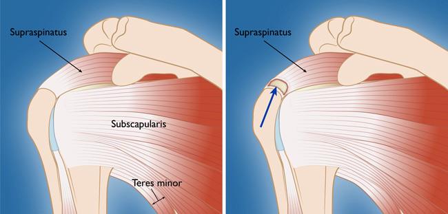 Shoulder Tendons Chart PART SHOULDER SERIES MOST COMMON DIAGNOSIS Shoulder