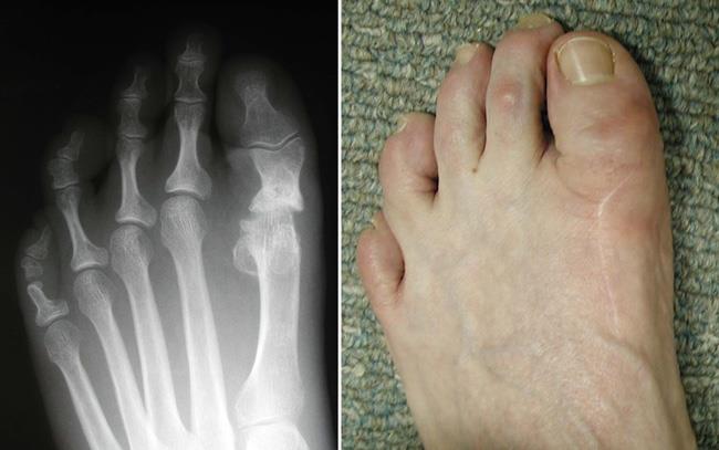 X-ray of a failed resection arthroplasty and photo of a shortened big toe