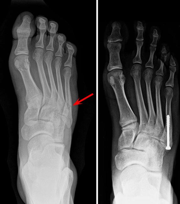 Toe And Forefoot Fractures Orthoinfo Aaos