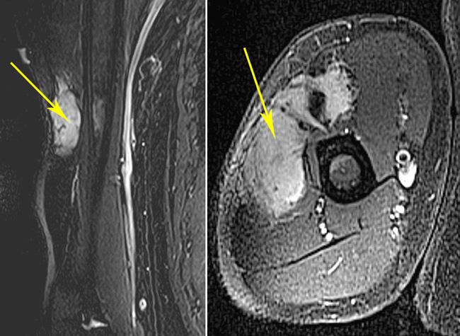 MRI scan of an extra-abdominal desmoid tumor