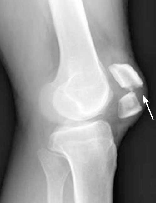 Patellar Fractures Broken Kneecap Orthoinfo Aaos