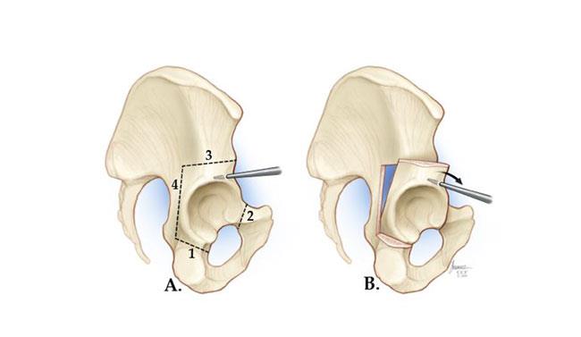 periacetabular osteotomy