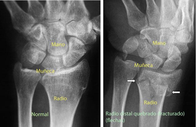 Fracturas Distales Del Radio Mu Eca Quebrada Distal Radius Fractures Broken Wrist