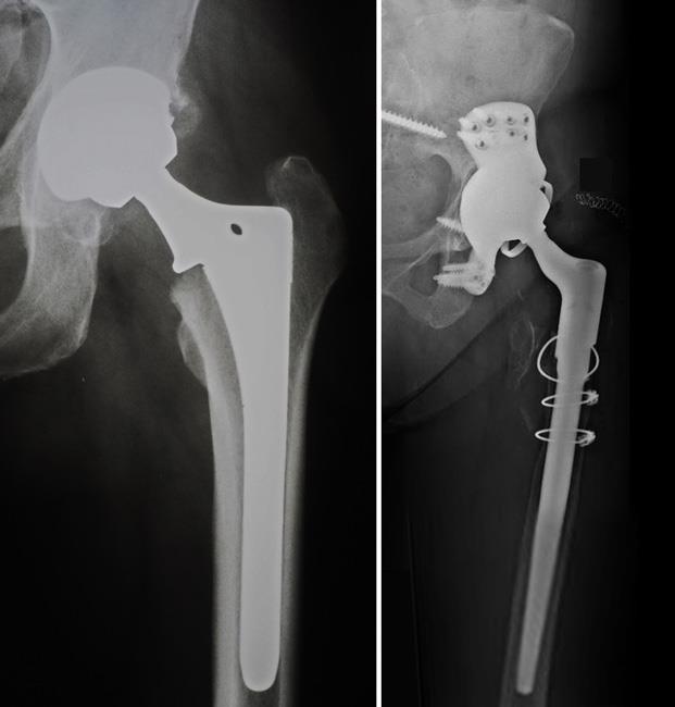 Revision Total Hip Replacement Orthoinfo Aaos