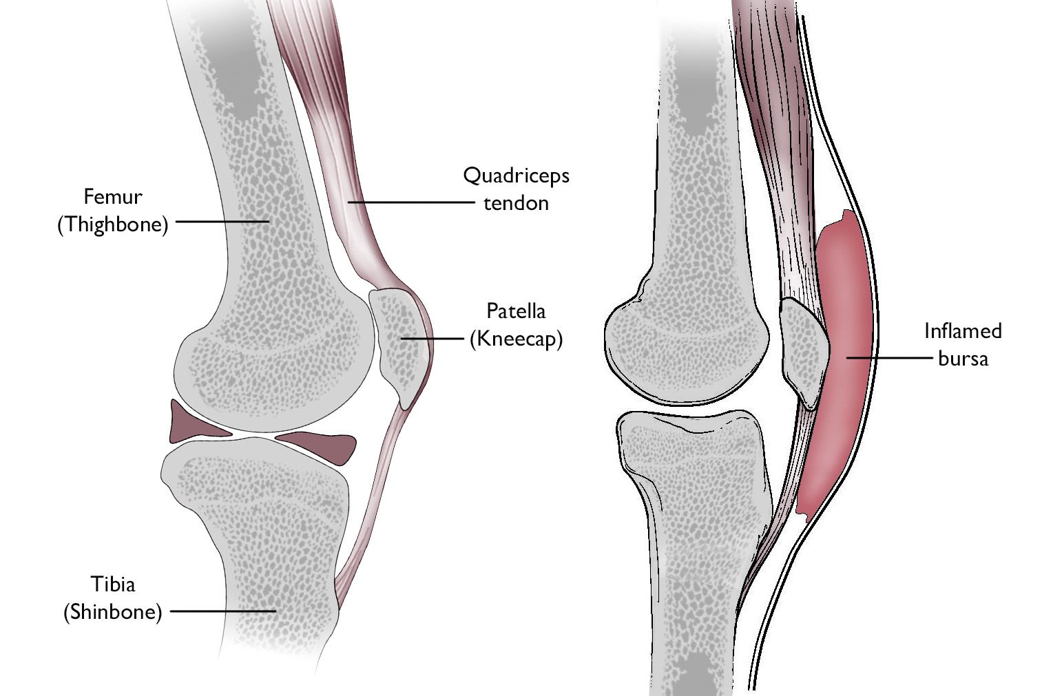 What is bursitis of the top of the knee cap?