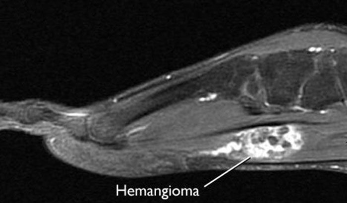 MRI of hemangioma