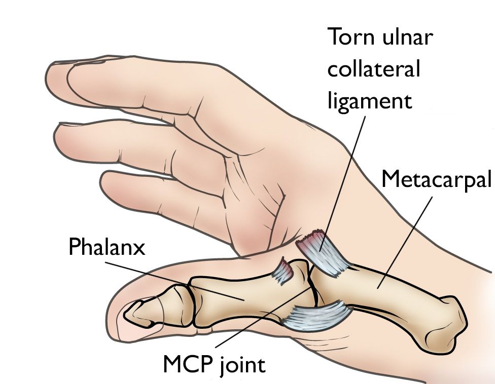 Sprained Thumb OrthoInfo AAOS