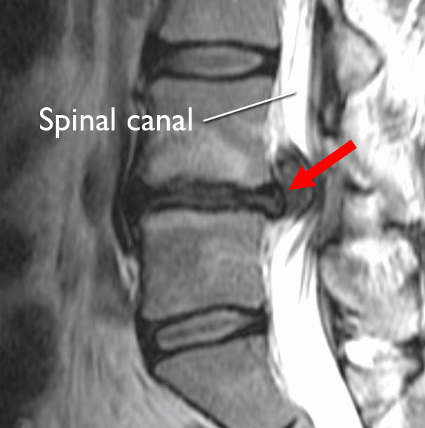 Herniated Disk In The Lower Back Orthoinfo Aaos