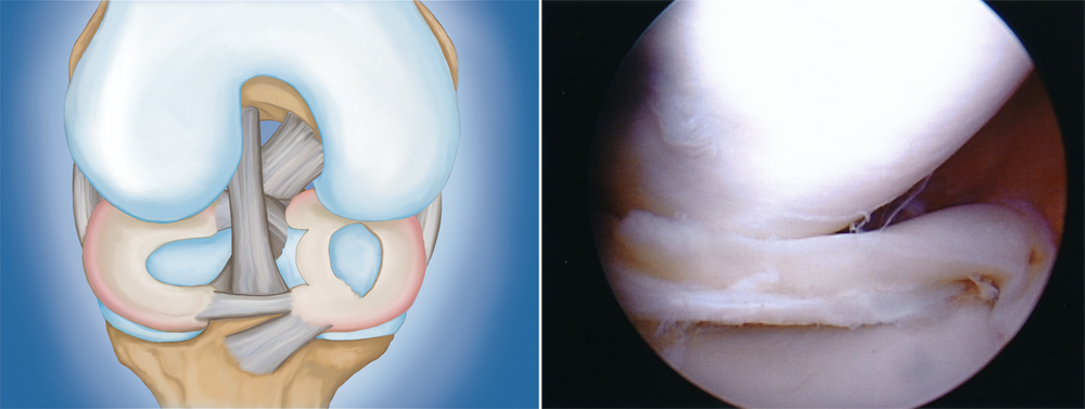 Illustration and photo of bucket handle meniscus tear