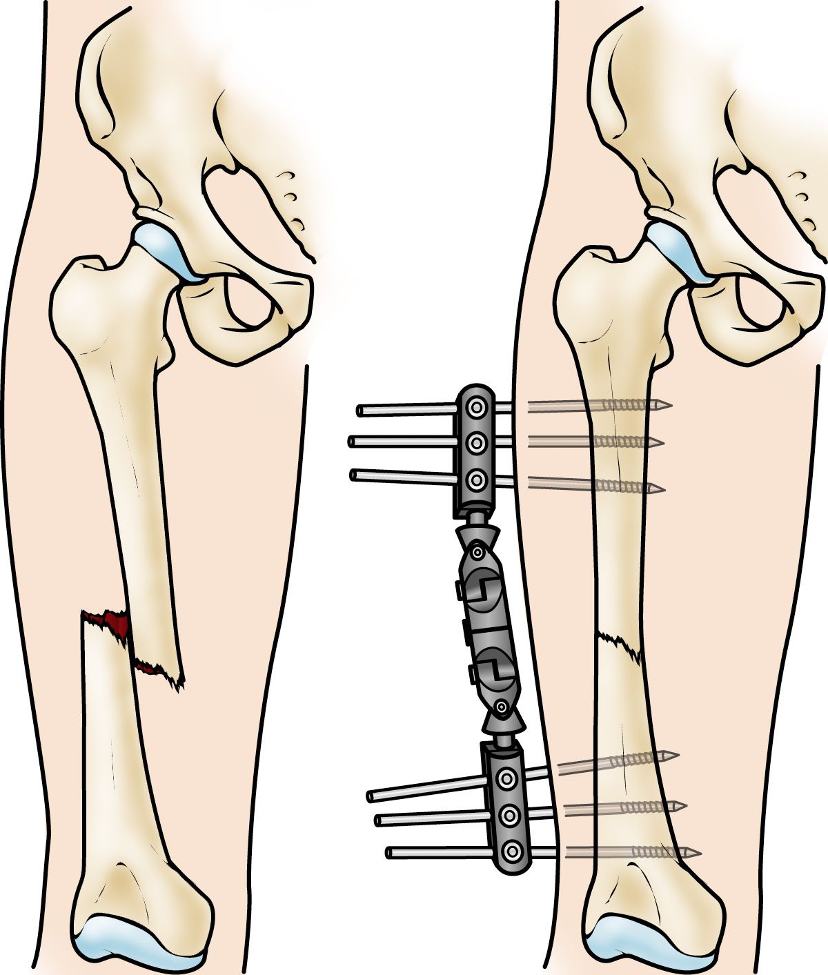 Internal Fixation For Fractures OrthoInfo AAOS