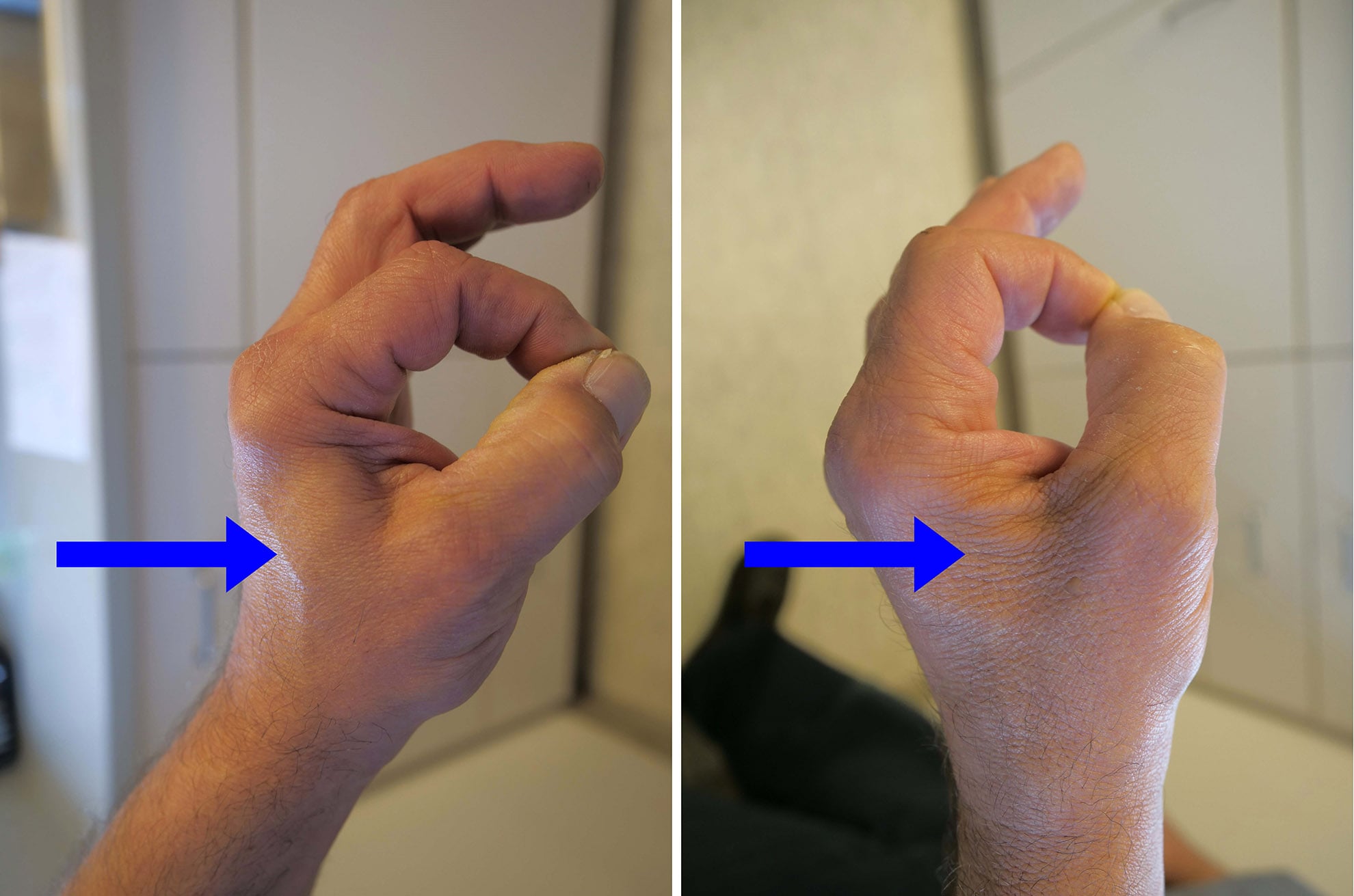 Ulnar Nerve Entrapment At The Elbow Cubital Tunnel Syndrome 