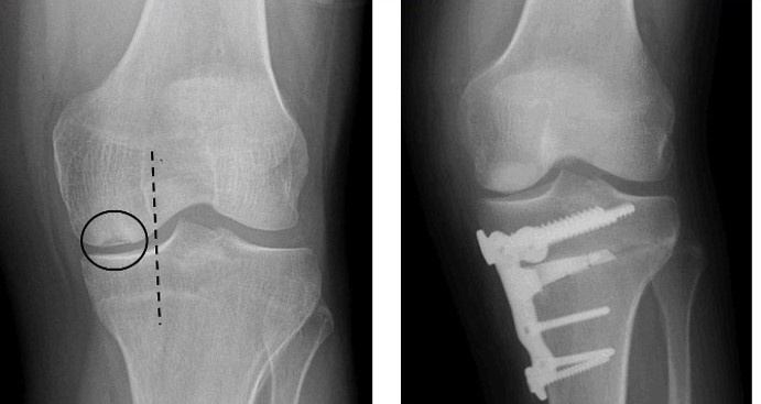 Osteotomy Of The Knee Orthoinfo Aaos