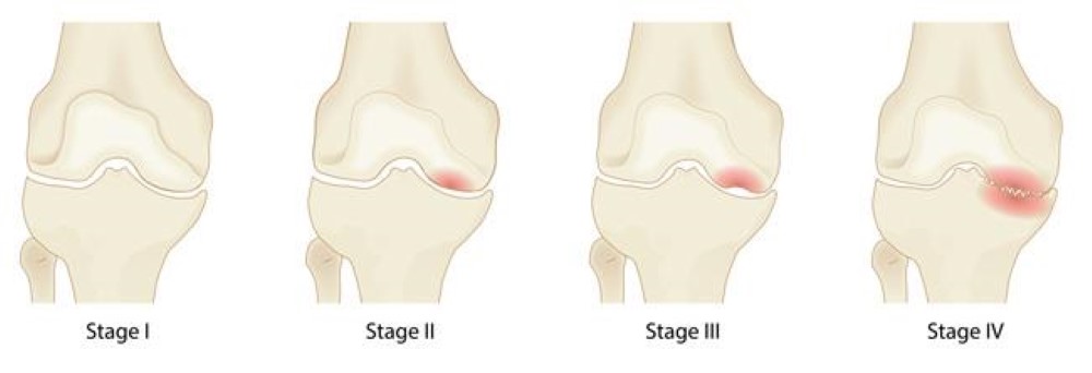 The four stages of osteonecrosis of the knee