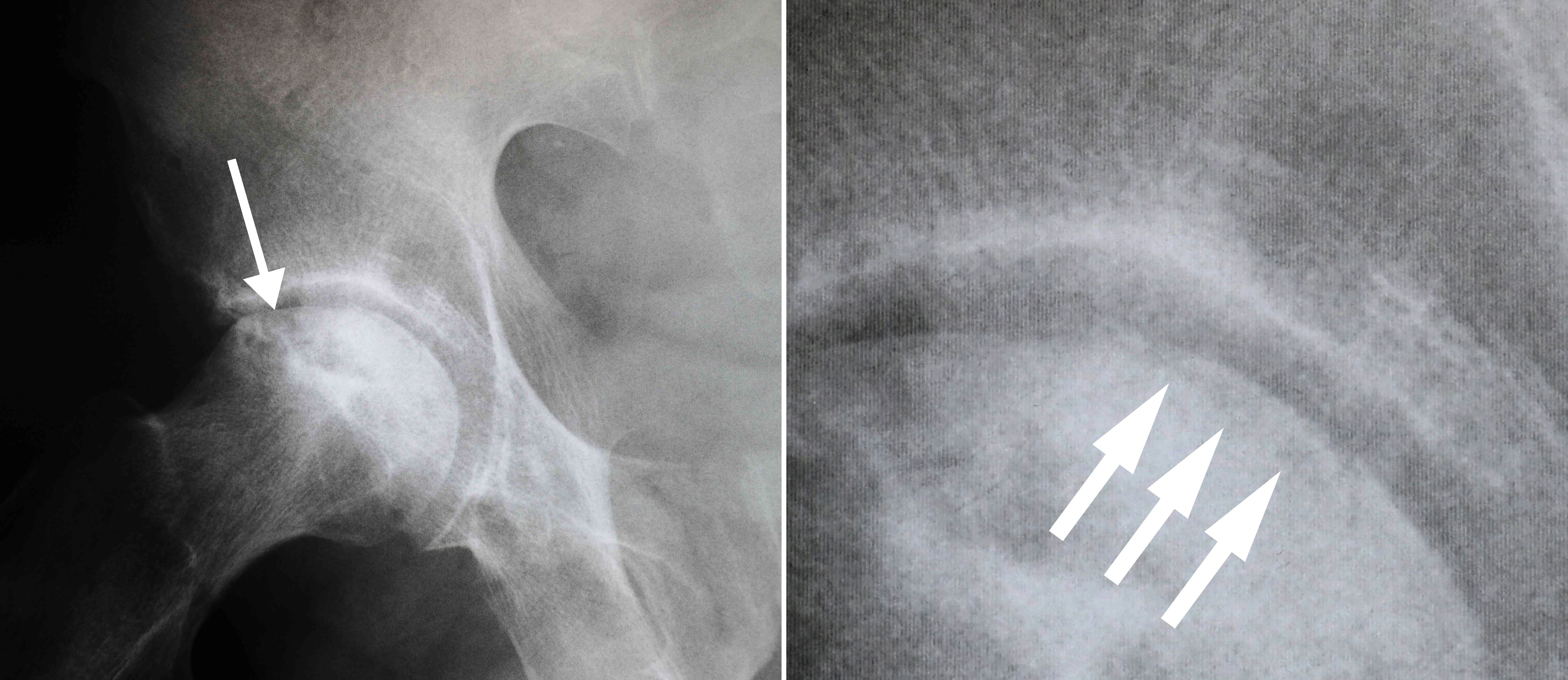 Osteonecrosis Of The Hip Orthoinfo Aaos