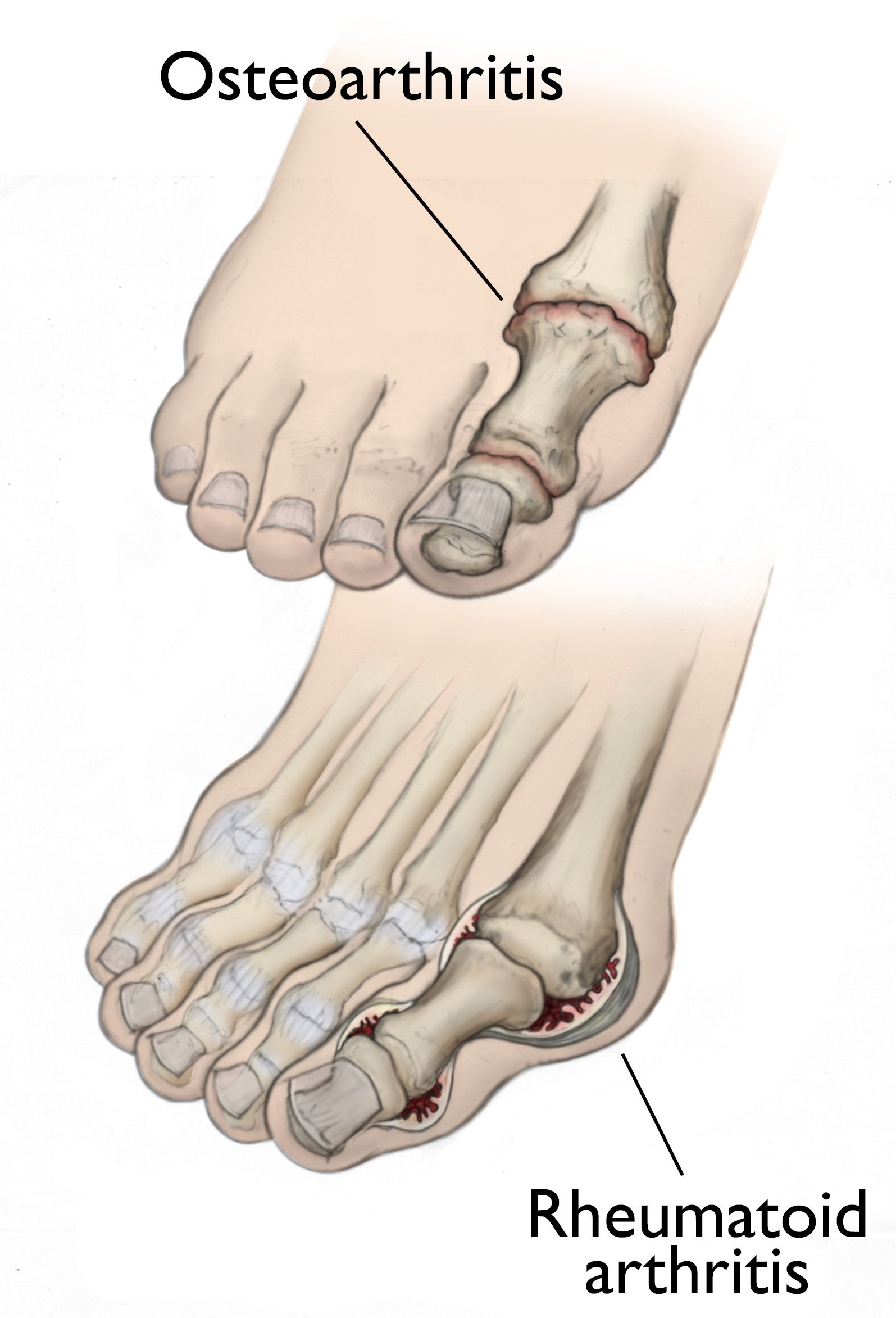 Arthritis Of The Foot And Ankle OrthoInfo AAOS