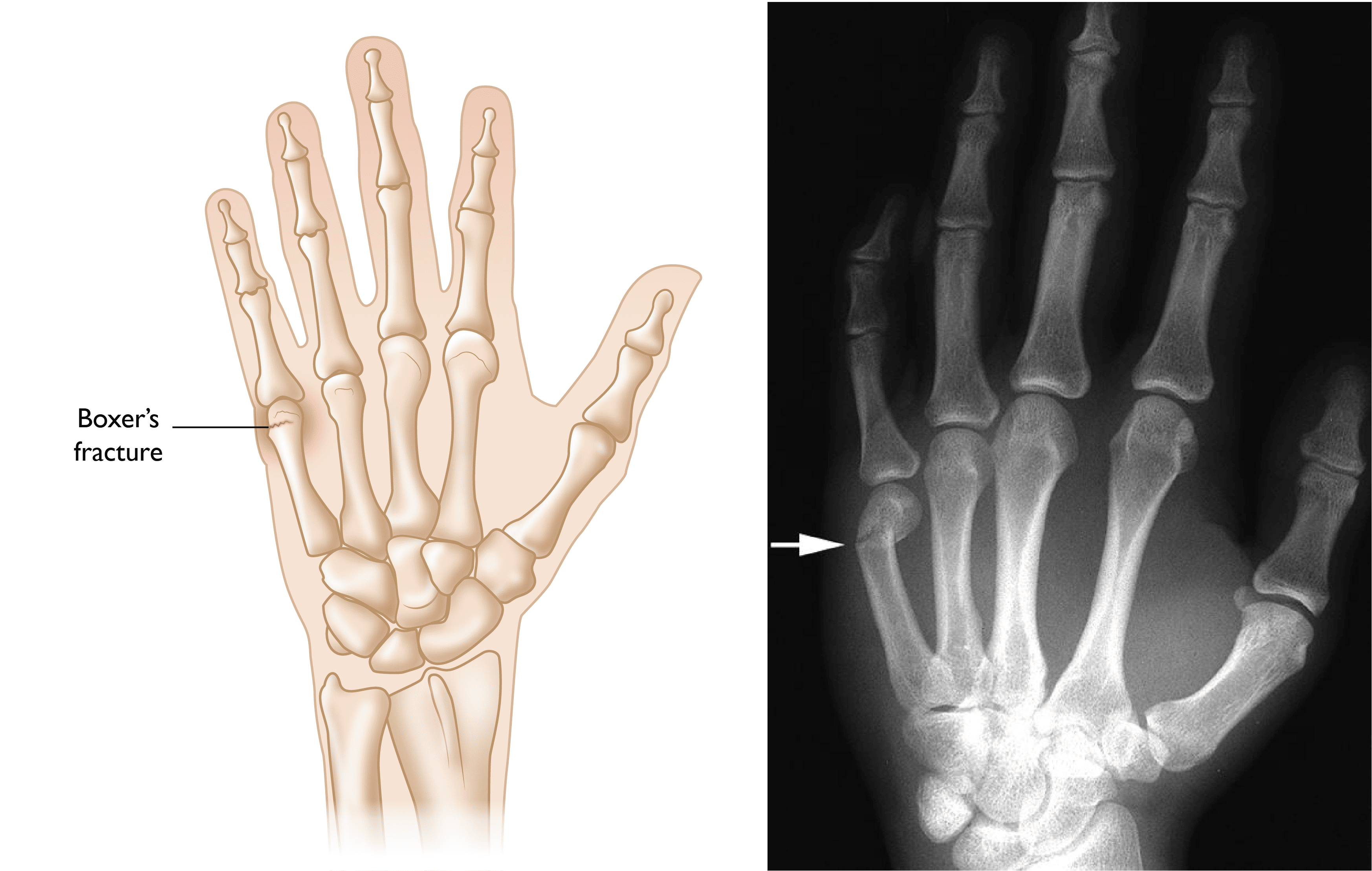 Boxer's Fracture