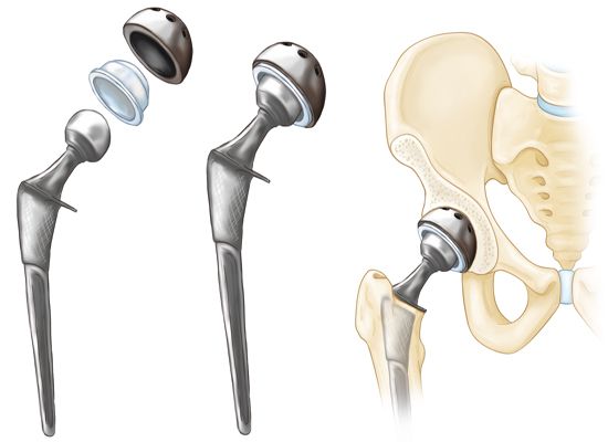 hip replacement components