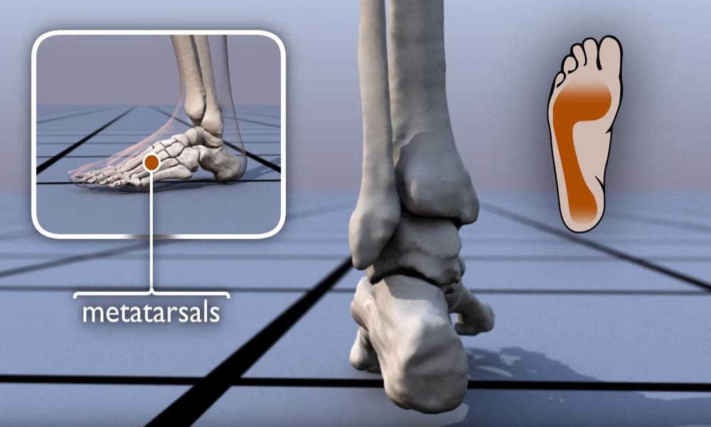 ankle pronation surgery