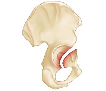 Acetabular Fractures - OrthoInfo - AAOS