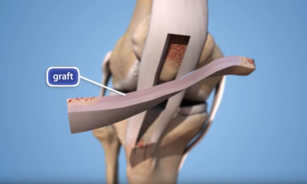 ACL Reconstruction Animation OrthoInfo AAOS