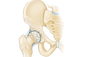 Hip Bone Spurs, Symptoms and Treatment