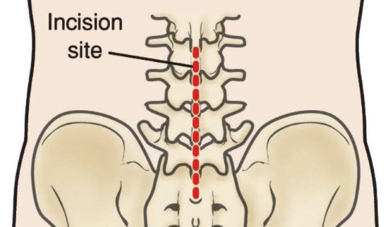 Fusión espinal (Spinal Fusion) - OrthoInfo -AAOS
