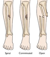 Tibia (Shinbone) Shaft Fractures - OrthoInfo - AAOS