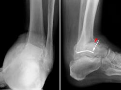 Pie diabético (Charcot) (Diabetic Charcot Foot ...