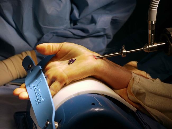 Endoscope inserted into wrist portal 