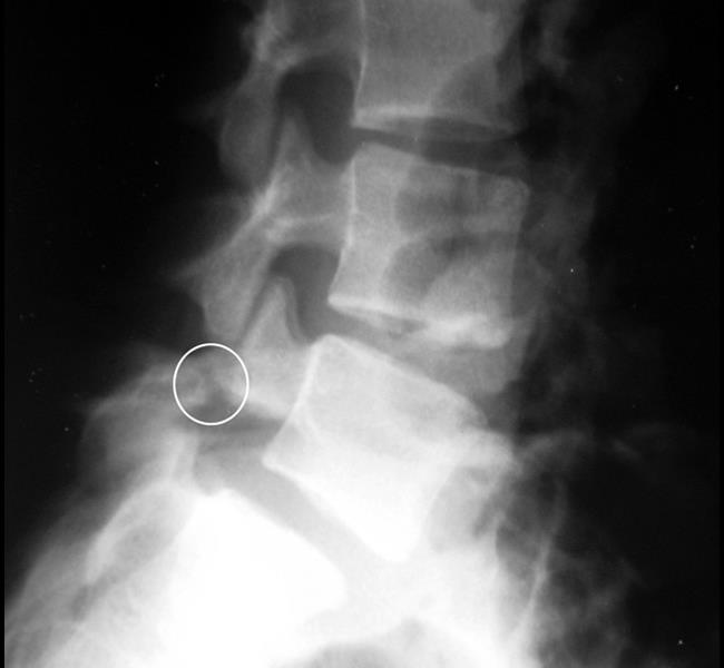 X-ray taken from the side shows a pars fracture in the fifth lumbar vertebra. 