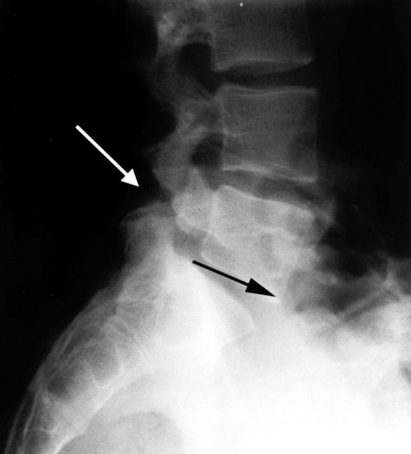 X-ray of spondylolisthesis