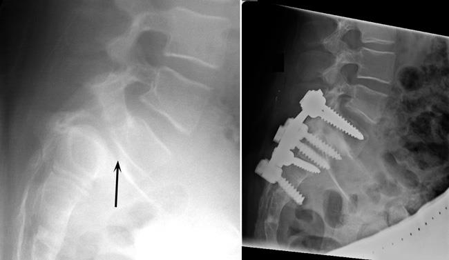 Spondylolisthesis treated with spinal fusion