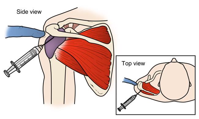 Cortisone injection in the shoulder
