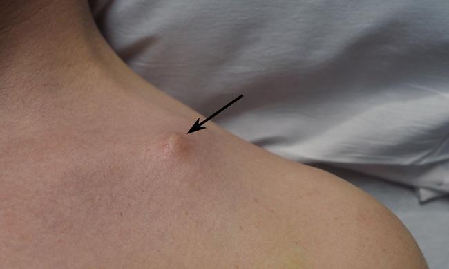 Tenting of skin over clavicle fracture