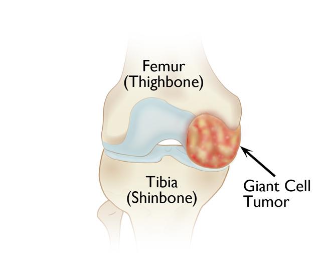 Giant cell tumor at end of thighbone