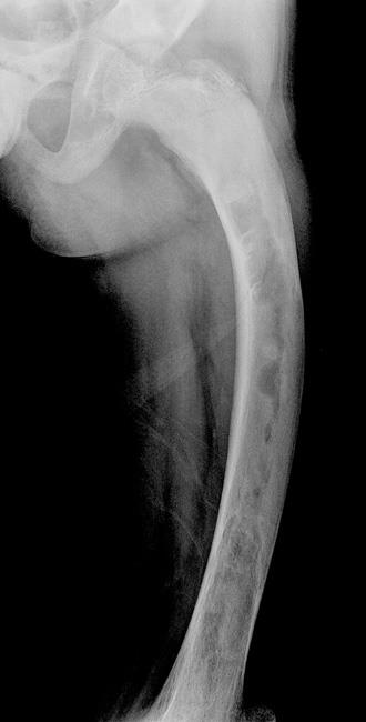 Bone deformity from fibrous dysplasia