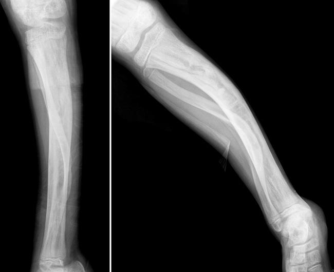 Bowing of tibia from fibrous dysplasia. 