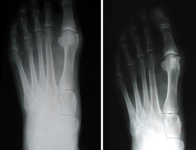 X-rays of a bunion before and after exostectomy