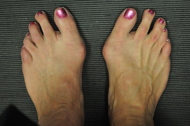 Photo of bunions on both feet