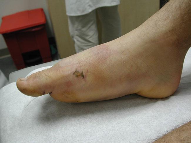 Fractured foot