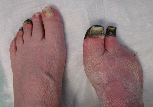 Toes damaged by frostbite