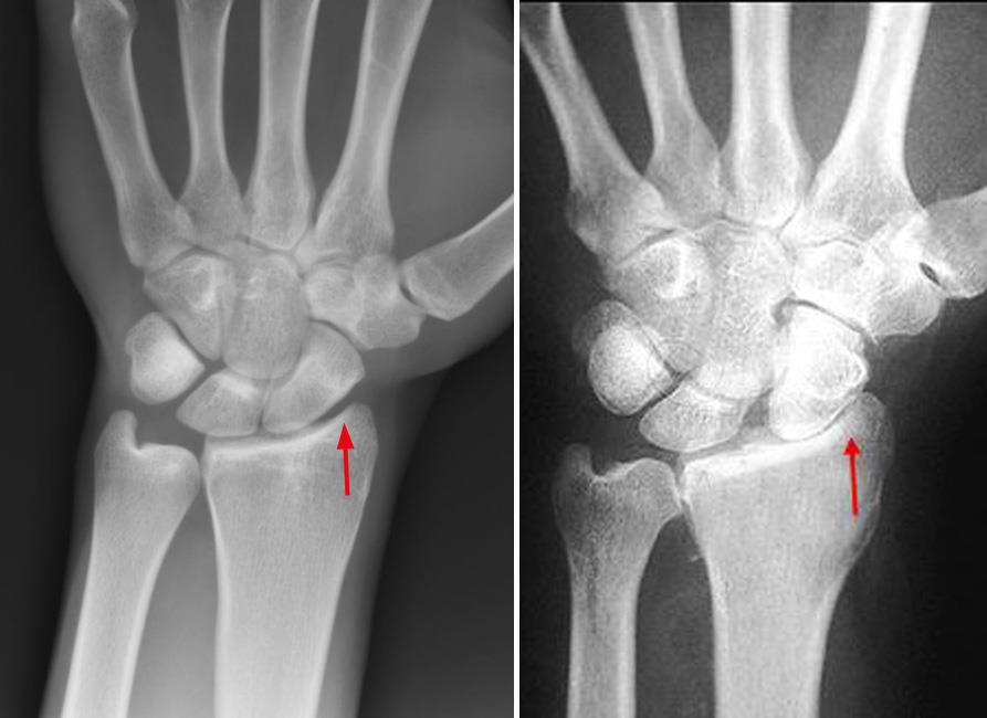 X-rays of healthy wrist and arthritic wrist