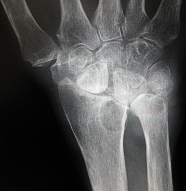 X-ray of wrist with rheumatoid arthritis