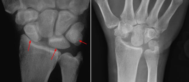 X-rays of wrist before and after proximal row carpectomy