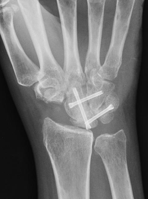 X-ray of partial wrist fusion