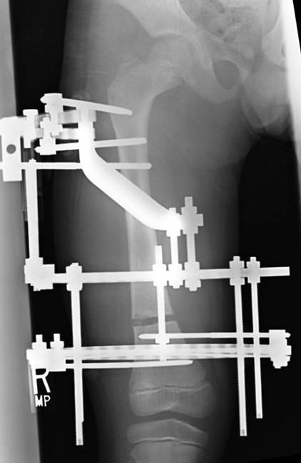 X-ray of limb lengthening using an external fixator