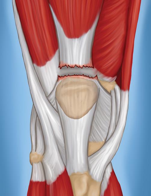 A complete tear of the quadriceps tendon 